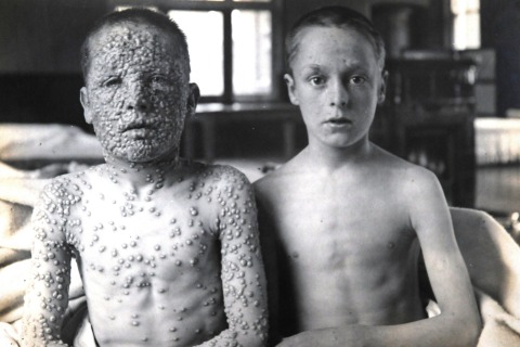Both boys were exposed to smallpox - boy on right had been vaccinated